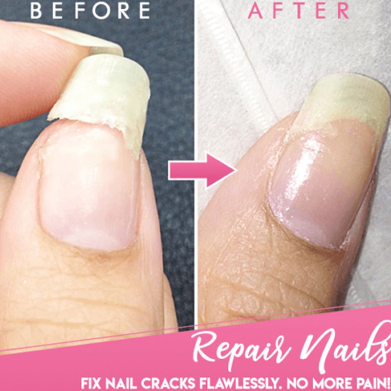 5 Pcs Instant Nail Gel - Protects Cracked Natural Nails - Nail Gel Kit For Emergencies